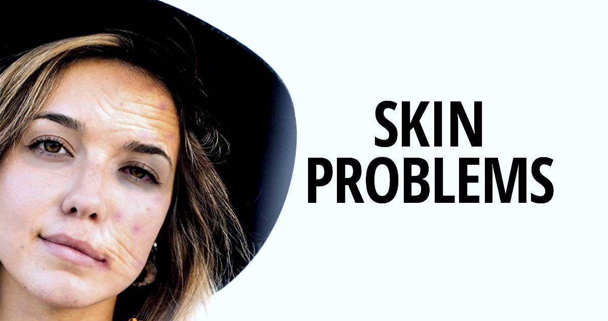 Loss of hydration can cause skin problems. Loss-of-hydration-can-cause-skin-problems