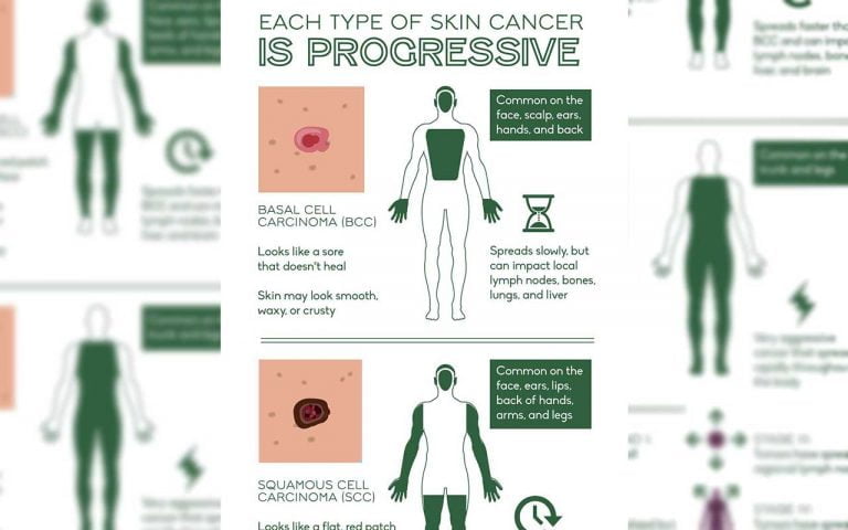 Save Your Skin From this Dangerous Disease. How to Detect Skin Cancer.