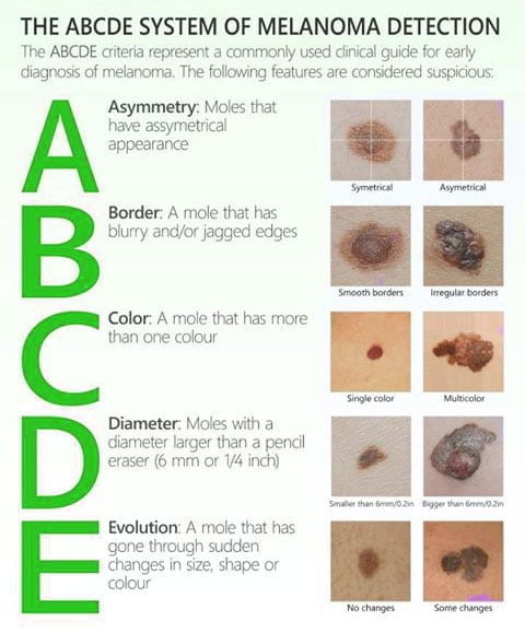 How to detect skin cancer and melanoma. Infographic.