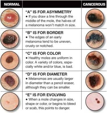 How to detect skin cancer by mole size and form. How-to-Detect-Skin-Cancer-moles