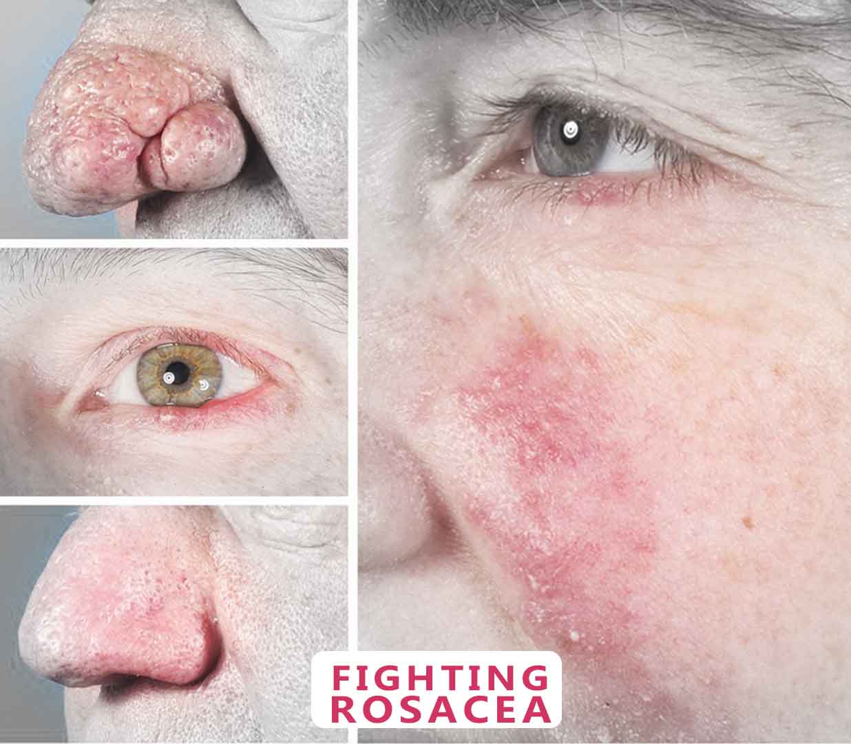 Fighting rosacea might be a challenge. But Proper precautions can reduce the effect of the disease. Erythematotelangiectatic-Rosacea-drugs-treatments