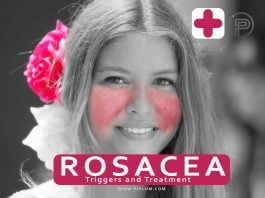 rosacea-treatment-triggers-drugs-redness-flush-healing-medicine