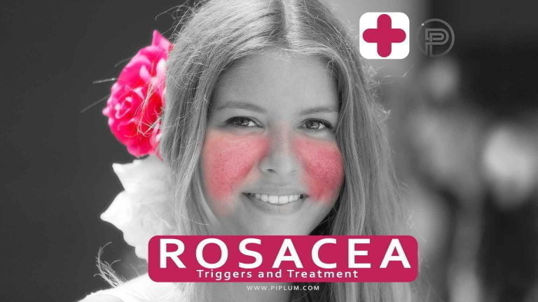 What Are The Symptoms Of Rosacea? What Are The Triggers And Risk Factors?