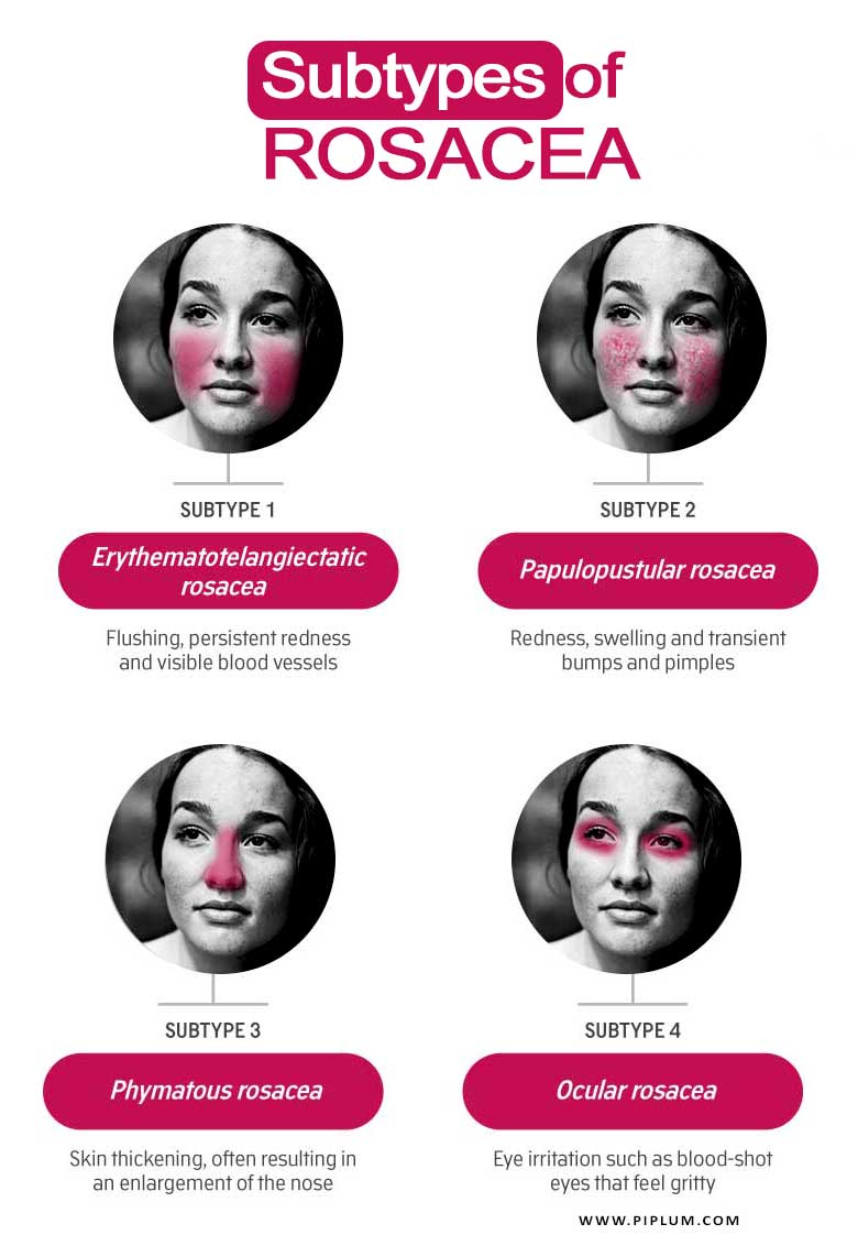 Subtypes-of-Rosacea-women-flush-face-redness-acne