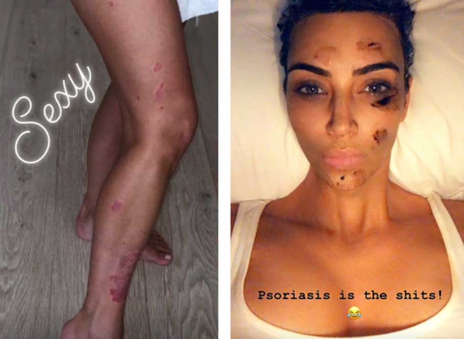 Kim Kardashian West is fighting with psoriasis. Celebrity-Kim-Kardashian-West-Has-Psoriasis