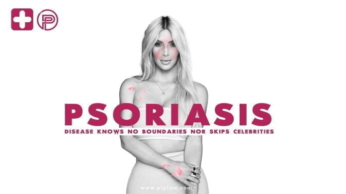 Psoriasis disease knows no boundaries nor skips celebrities. Kim-Kardashian-Psoriasis-treatment-methods
