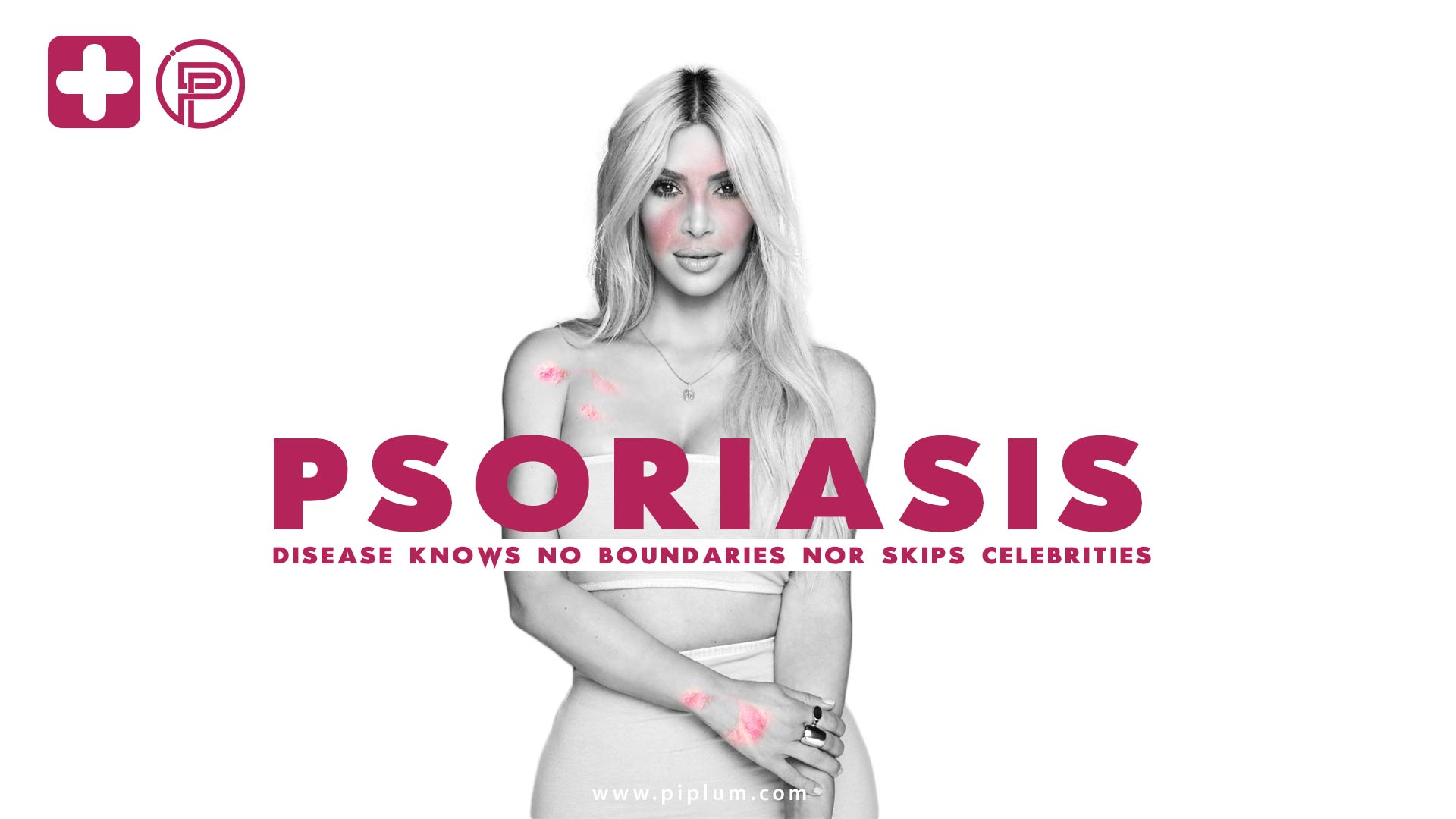 Kim-Kardashian-Psoriasis-treatment-methods