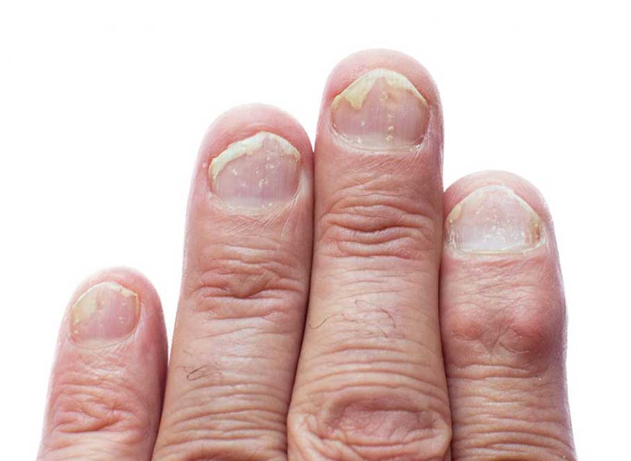 Nail-Psoriasis-causes-remedies-healing-treatments-drugs