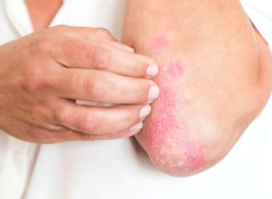 The-most-common-symptoms-of-psoriasis-are-skin-rashes-or-red-patches