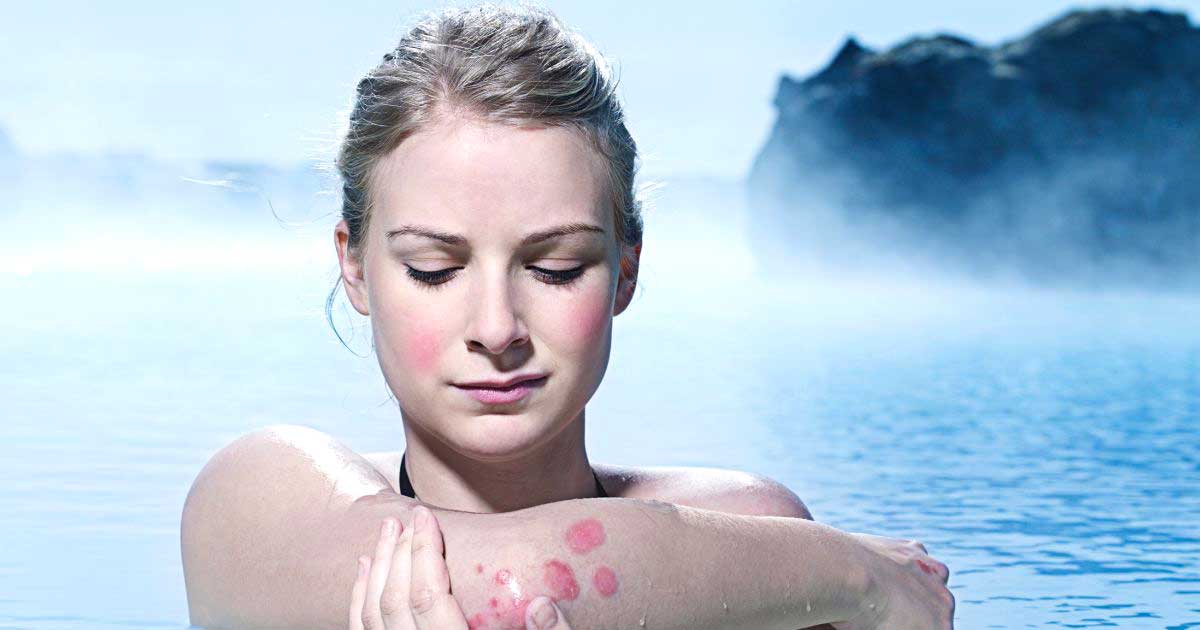 Psoriasis-triggers-geothermal-seawater-a-resource-with-scientifically-proven-healing-benefits-blue-lagoon