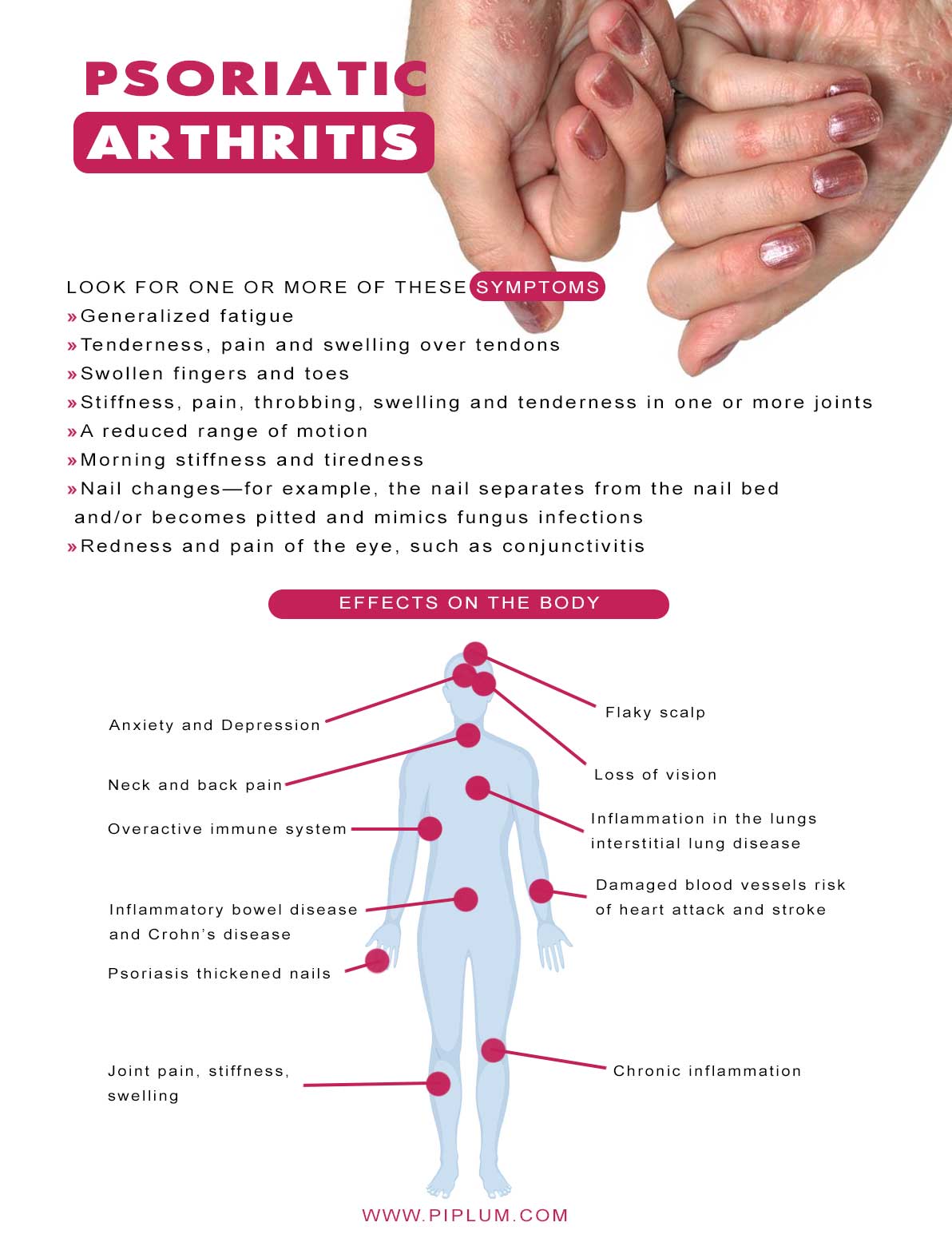 psoriatic-arthritis-affects-on-the-body-and-symptoms-infographic-poster-list-remedies